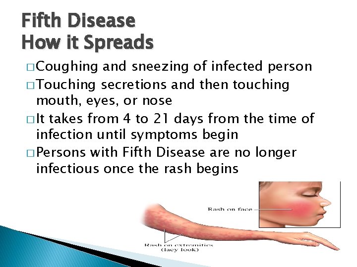 Fifth Disease How it Spreads � Coughing and sneezing of infected person � Touching