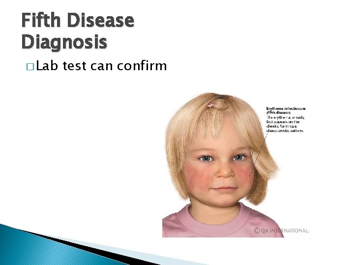 Fifth Disease Diagnosis � Lab test can confirm 