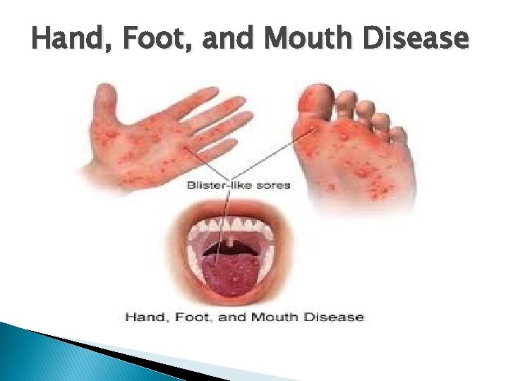 Hand, Foot, and Mouth Disease 