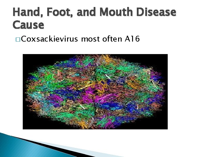 Hand, Foot, and Mouth Disease Cause � Coxsackievirus most often A 16 