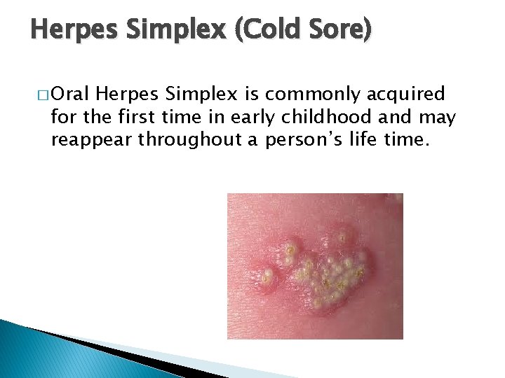 Herpes Simplex (Cold Sore) � Oral Herpes Simplex is commonly acquired for the first