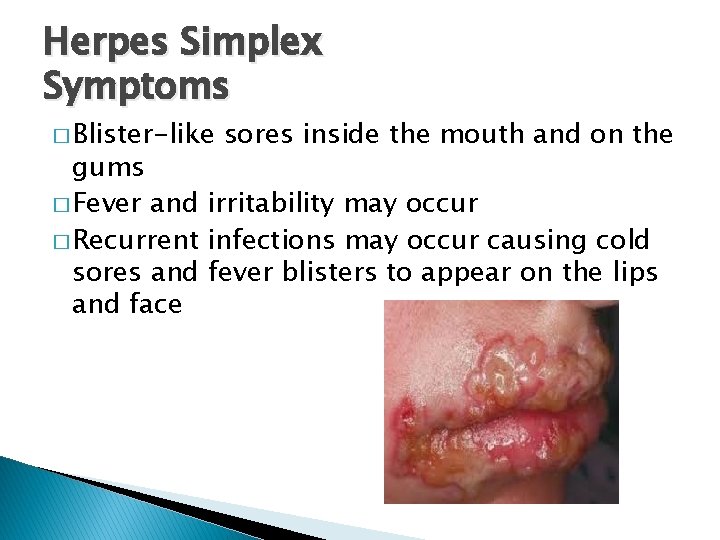 Herpes Simplex Symptoms � Blister-like sores inside the mouth and on the gums �