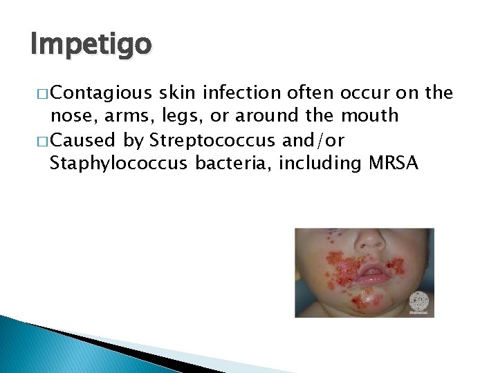 Impetigo � Contagious skin infection often occur on the nose, arms, legs, or around