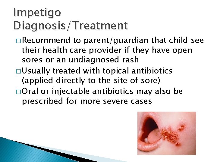 Impetigo Diagnosis/Treatment � Recommend to parent/guardian that child see their health care provider if