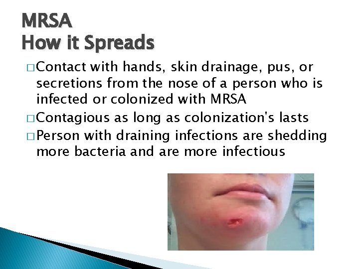 MRSA How it Spreads � Contact with hands, skin drainage, pus, or secretions from