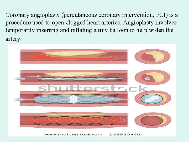 Coronary angioplasty (percutaneous coronary intervention, PCI) is a procedure used to open clogged heart