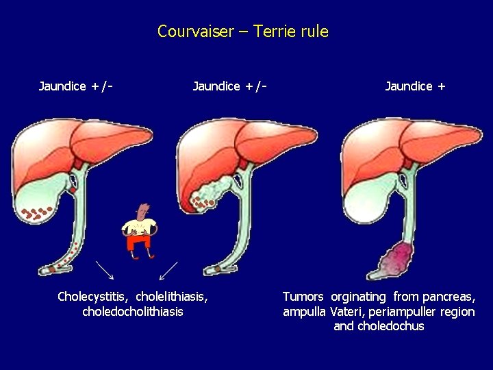 Courvaiser – Terrie rule Jaundice +/- Cholecystitis, cholelithiasis, choledocholithiasis Jaundice + Tumors orginating from