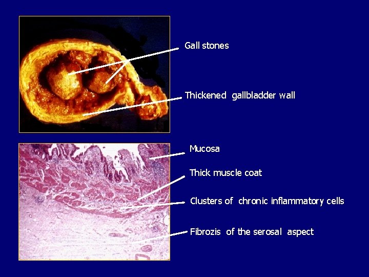 Gall stones Thickened gallbladder wall Mucosa Thick muscle coat Clusters of chronic inflammatory cells