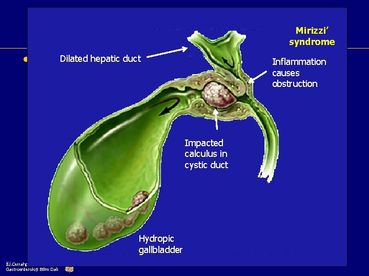 Complications of gallstones Mirizzi’ syndrome hepatic duct may develop in 10% of • Some.