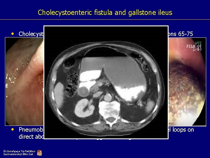 Cholecystoenteric fistula and gallstone ileus • Cholecystoenteric fistulas (CEF) are typically seen in persons