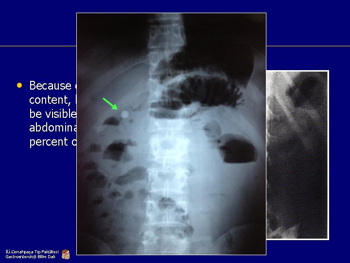 Direcy abdominal graphy • Because of calcium content, bile stones may be visible on