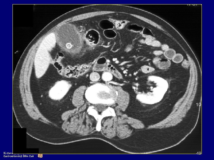 İÜ. Cerrahpaşa Tıp Fakültesi Gastroenteroloji Bilim Dalı 49 