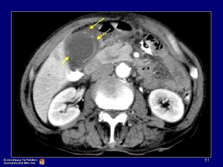 İÜ. Cerrahpaşa Tıp Fakültesi Gastroenteroloji Bilim Dalı 51 