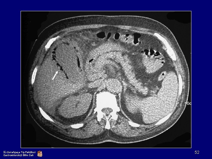 İÜ. Cerrahpaşa Tıp Fakültesi Gastroenteroloji Bilim Dalı 52 
