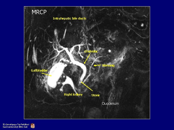 MRCP Intrahepatic bile ducts Choledoc Wirsung Gallbladder Right kidney Stone Duodenum İÜ. Cerrahpaşa Tıp