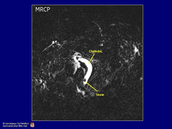 MRCP Choledoc Stone İÜ. Cerrahpaşa Tıp Fakültesi Gastroenteroloji Bilim Dalı 