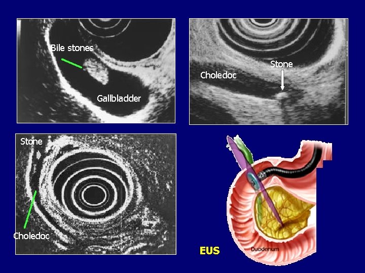 Bile stones Stone Choledoc Gallbladder Stone Choledoc EUS 
