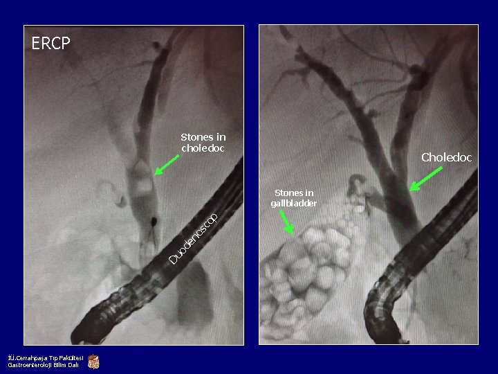 ERCP Stones in choledoc Choledoc Du od e no sc op Stones in gallbladder