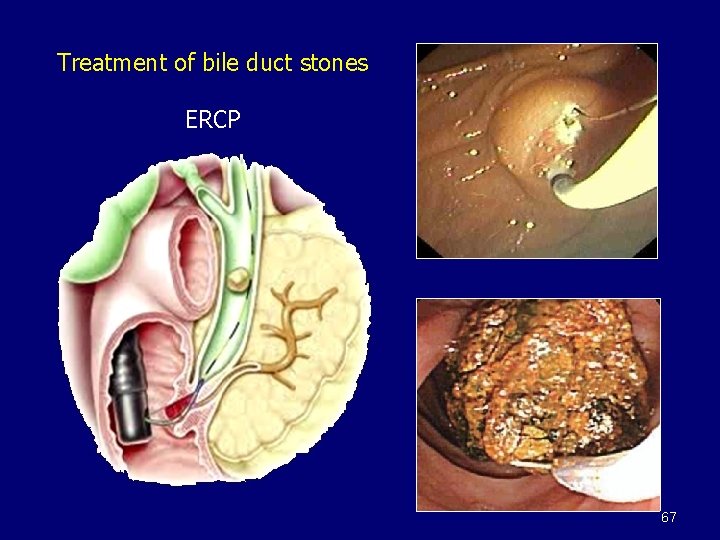 Treatment of bile duct stones ERCP 67 