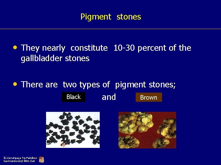 Pigment stones • They nearly constitute 10 -30 percent of the gallbladder stones •
