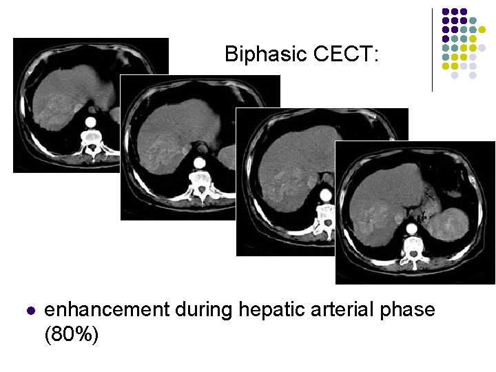 Biphasic CECT: l enhancement during hepatic arterial phase (80%) 