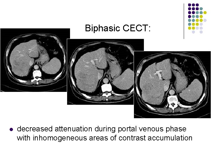 Biphasic CECT: l decreased attenuation during portal venous phase with inhomogeneous areas of contrast