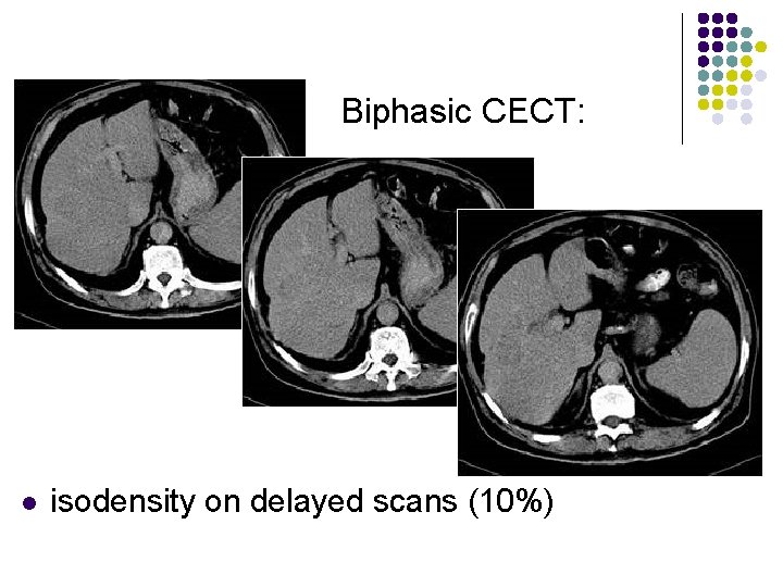 Biphasic CECT: l isodensity on delayed scans (10%) 