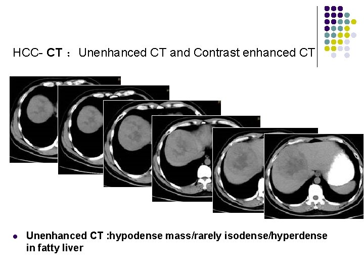 HCC- CT ：Unenhanced CT and Contrast enhanced CT l Unenhanced CT : hypodense mass/rarely