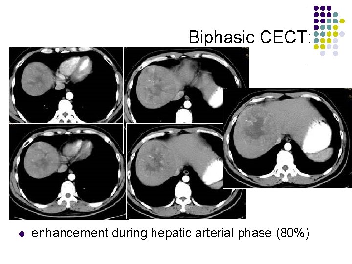 Biphasic CECT: l enhancement during hepatic arterial phase (80%) 