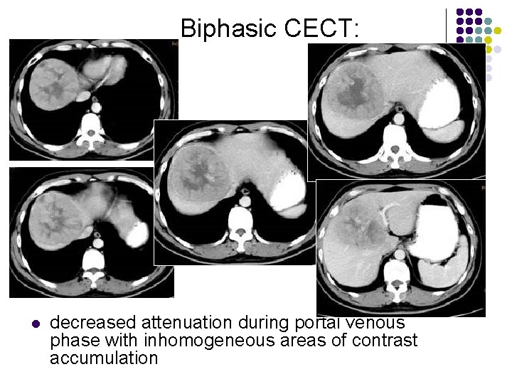 Biphasic CECT: l decreased attenuation during portal venous phase with inhomogeneous areas of contrast