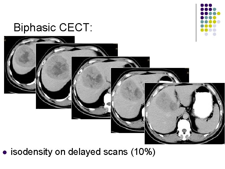 Biphasic CECT: l isodensity on delayed scans (10%) 
