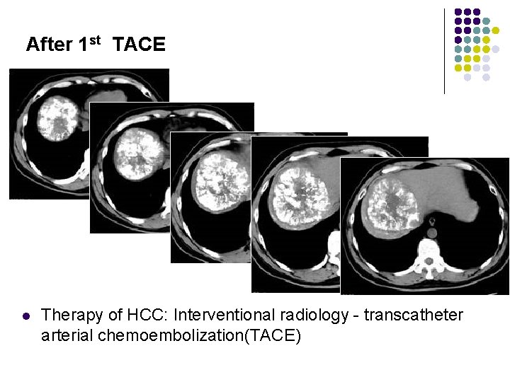 After 1 st TACE l Therapy of HCC: Interventional radiology - transcatheter arterial chemoembolization(TACE)