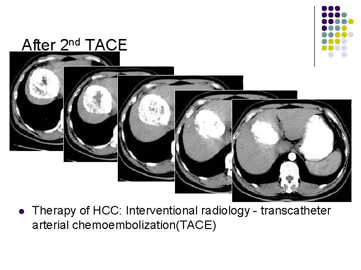 After 2 nd TACE l Therapy of HCC: Interventional radiology - transcatheter arterial chemoembolization(TACE)