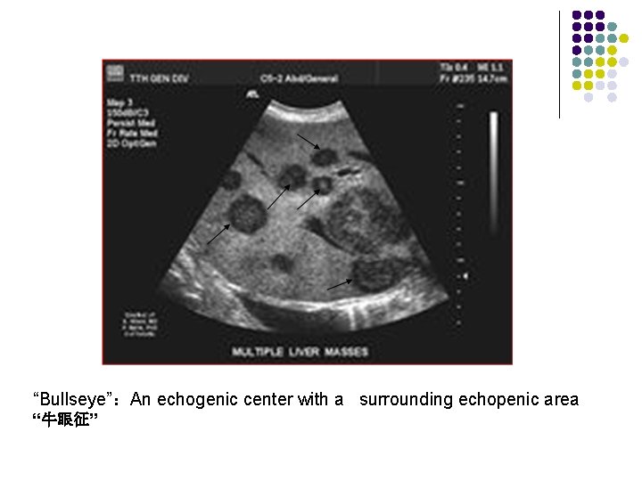 “Bullseye”：An echogenic center with a surrounding echopenic area “牛眼征” 