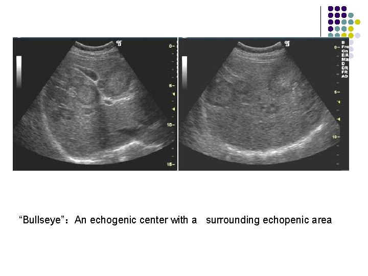 “Bullseye”：An echogenic center with a surrounding echopenic area 