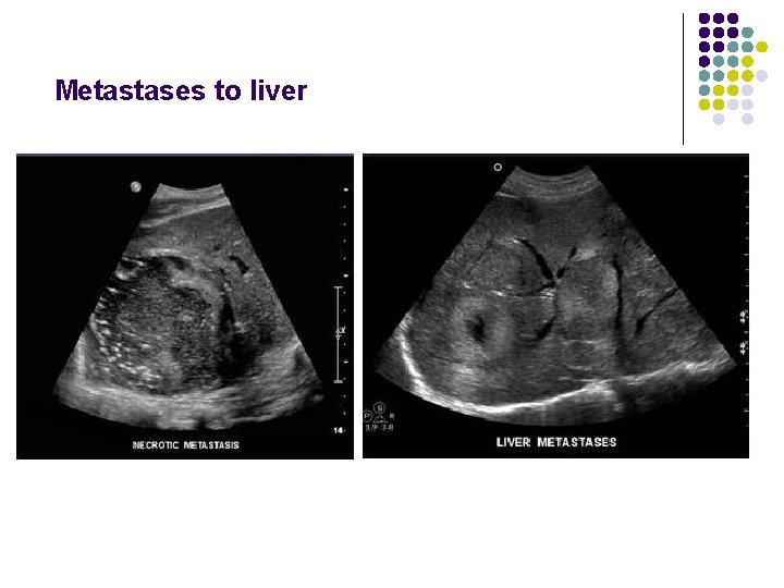 Metastases to liver 