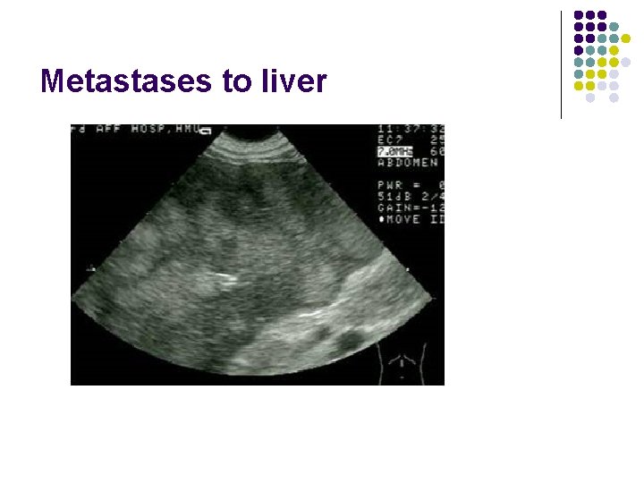 Metastases to liver 