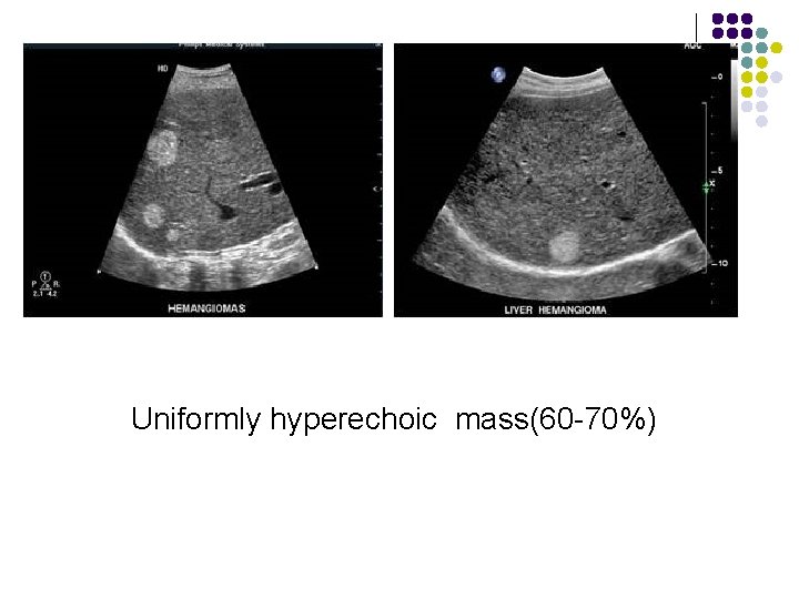 。 Uniformly hyperechoic mass(60 -70%) 