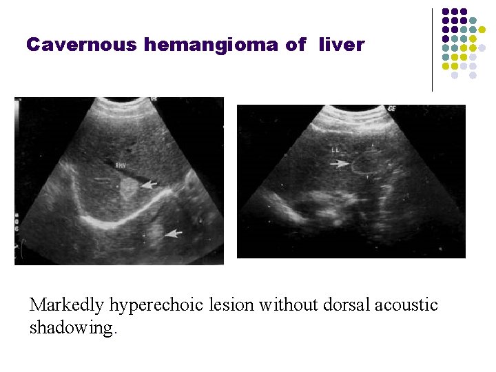Cavernous hemangioma of liver Markedly hyperechoic lesion without dorsal acoustic shadowing. 