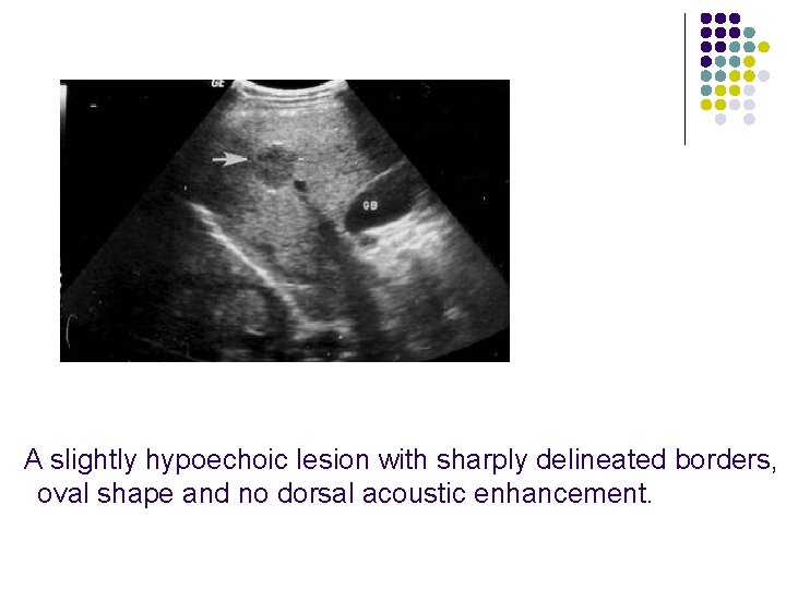 A slightly hypoechoic lesion with sharply delineated borders, oval shape and no dorsal acoustic