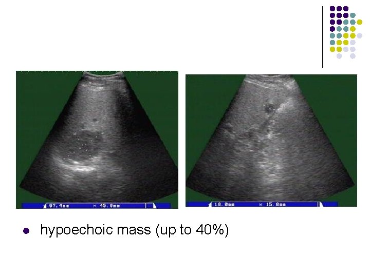 l hypoechoic mass (up to 40%) 