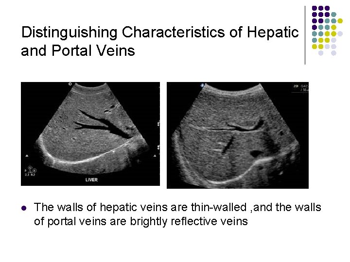 Distinguishing Characteristics of Hepatic and Portal Veins l The walls of hepatic veins are