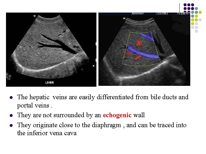 l l l The hepatic veins are easily differentiated from bile ducts and portal