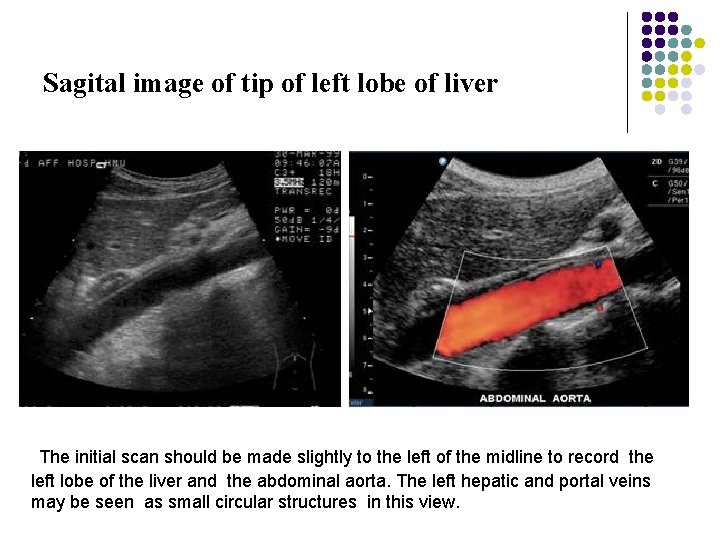 Sagital image of tip of left lobe of liver The initial scan should be
