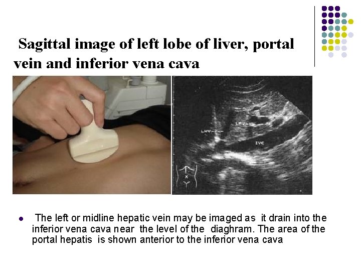 Sagittal image of left lobe of liver, portal vein and inferior vena cava l