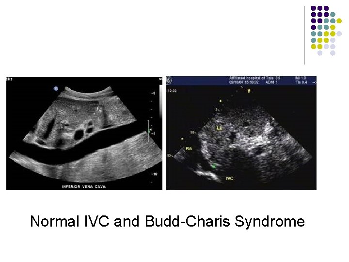 Normal IVC and Budd-Charis Syndrome 