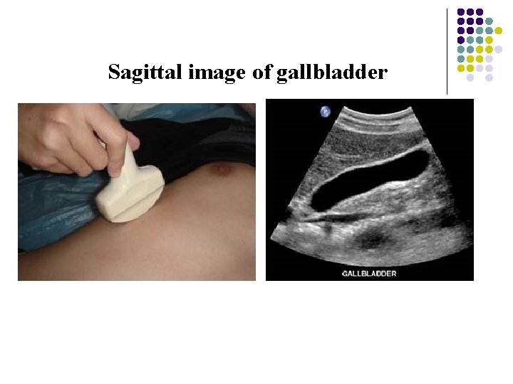 Sagittal image of gallbladder 