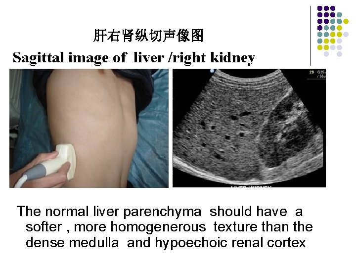 肝右肾纵切声像图 Sagittal image of liver /right kidney The normal liver parenchyma should have a