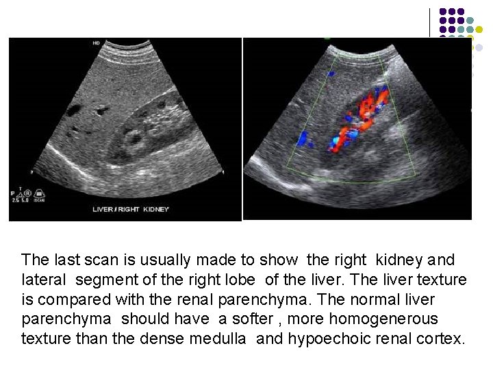 The last scan is usually made to show the right kidney and lateral segment