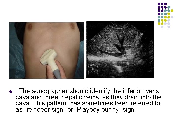 l The sonographer should identify the inferior vena cava and three hepatic veins as